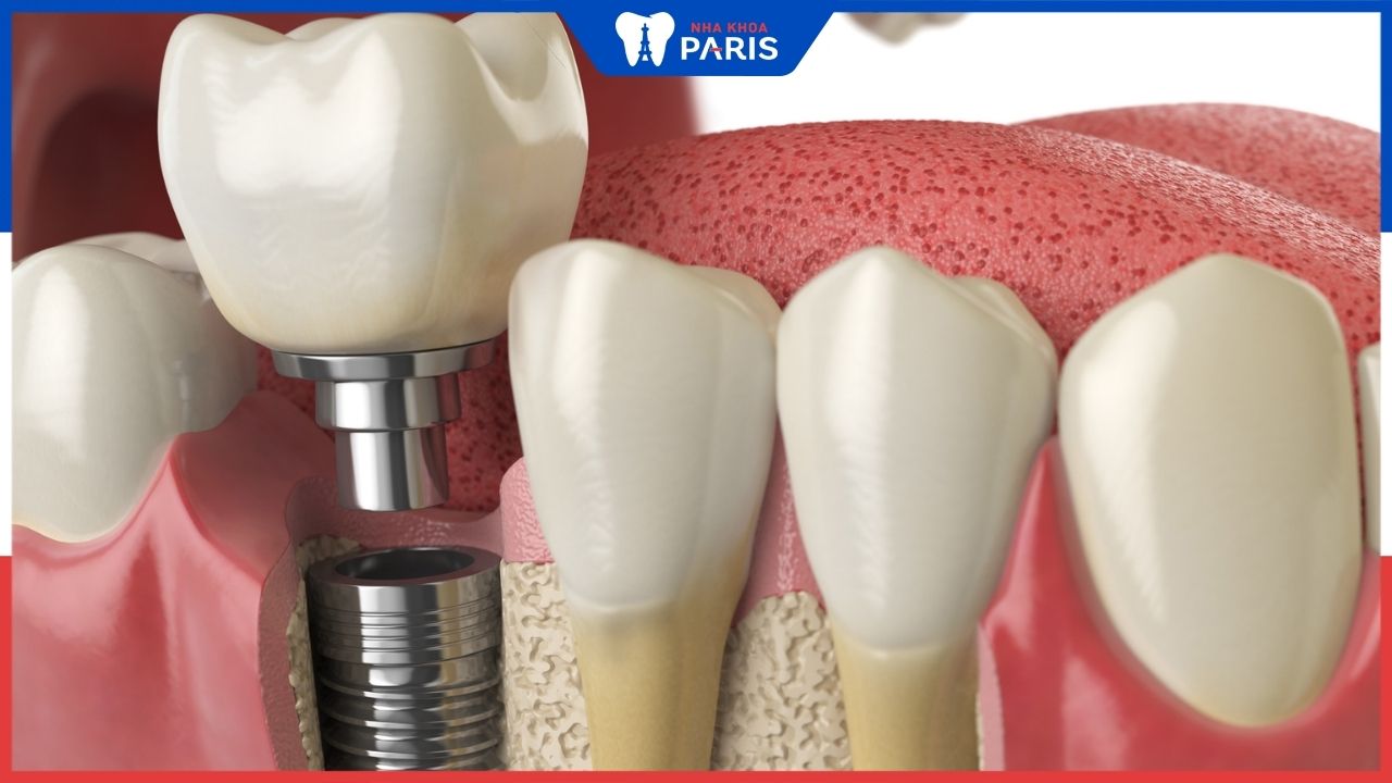 Cấy trụ Implant bao lâu thì gắn răng – 5 yếu tố ảnh hưởng