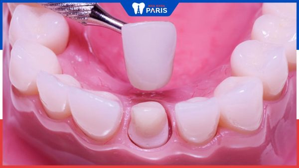 Cùi giả Zirconia: Giải pháp cho răng bị hư tổn nặng