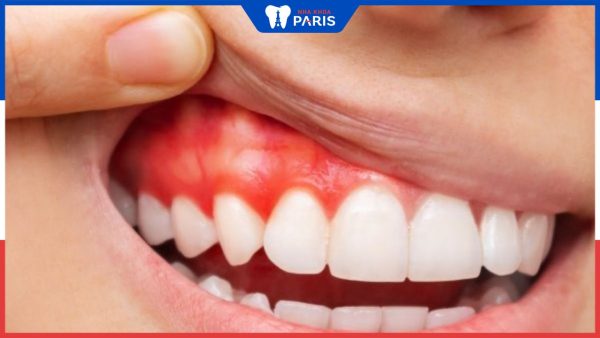 Cuống răng nằm ở đâu? Nguyên nhân bệnh viêm quanh cuống răng