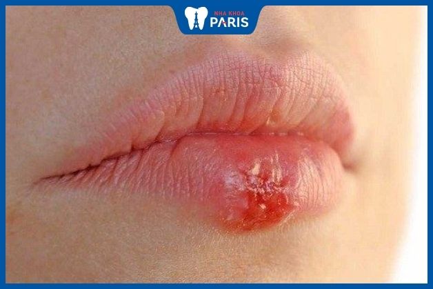 Bệnh Herpes môi có nguy hiểm không