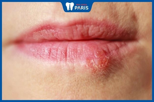 Herpes môi khi nào cần khám bác sĩ