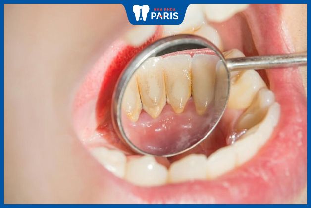 Lấy cao răng để loại bỏ vi khuẩn