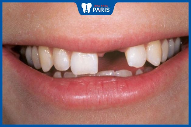 Răng không mọc lại hưởng đến chức năng ăn nhai và sức khỏe