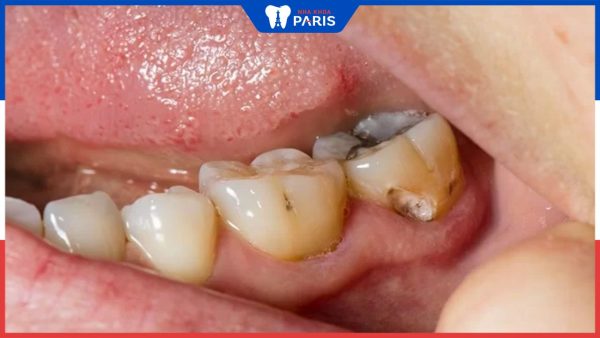 Nên làm gì khi răng bị sâu? Cách trị dứt điểm sâu răng