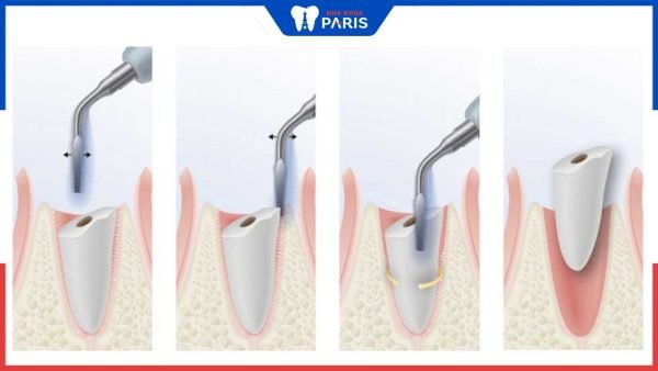 Tìm hiểu về kỹ thuật nhổ răng không sang chấn