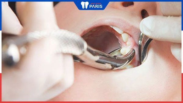 Nhổ răng tiểu phẫu là gì? Khi nào cần thực hiện