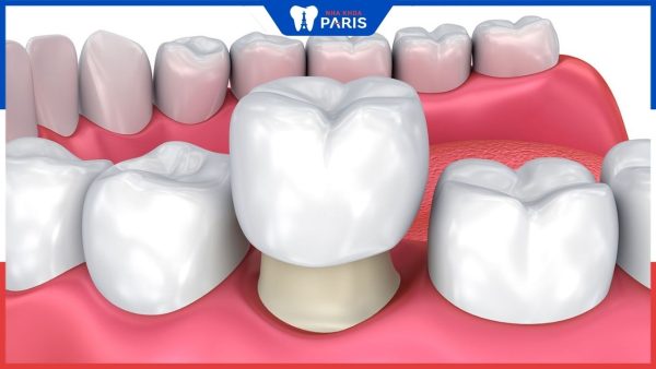 6 Nhược điểm của việc bọc răng sứ – Bác sĩ nha khoa Đàm ngọc trâm cho biết
