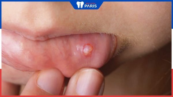 Nổi cục trong miệng không đau là bệnh gì?