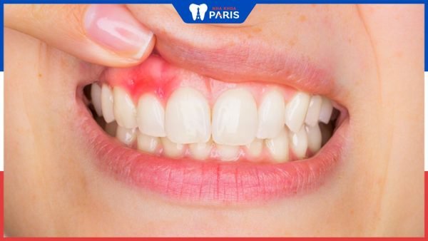 Nướu răng đỏ, sưng đau cảnh báo điều gì? Cách xử lý nhanh chóng
