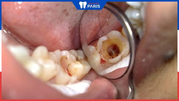 Răng sâu có mủ: Nhận biết, Cách điều trị và Phòng ngừa