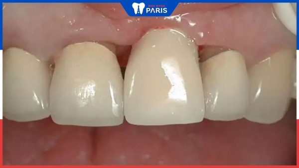 Răng sứ hết hạn sau khi sử dụng bao lâu – 3 dấu hiệu nhận biết
