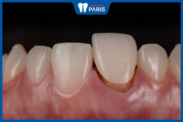 Răng sứ bị lung lay ảnh hưởng đến sức khỏe răng miệng