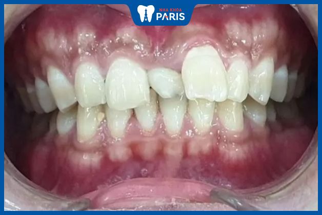 Răng thừa mọc ở giữa 2 răng cửa do di truyền