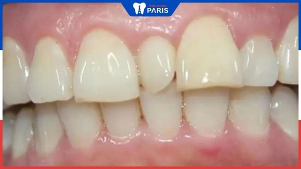 Răng thừa mọc giữa 2 răng cửa: Nguyên nhân và biện pháp xử lý