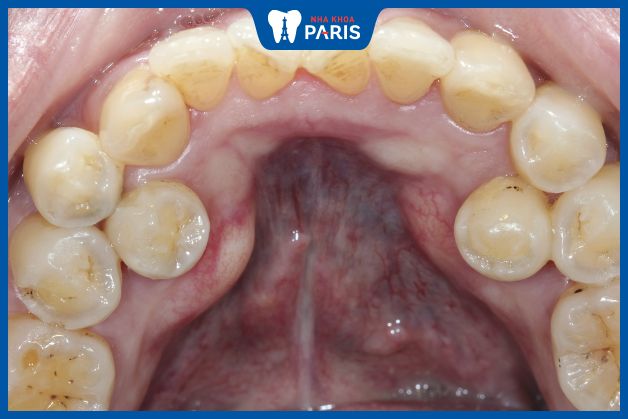 Răng vĩnh viễn mọc lệch vào bên trong do cấu trúc hàm nhỏ