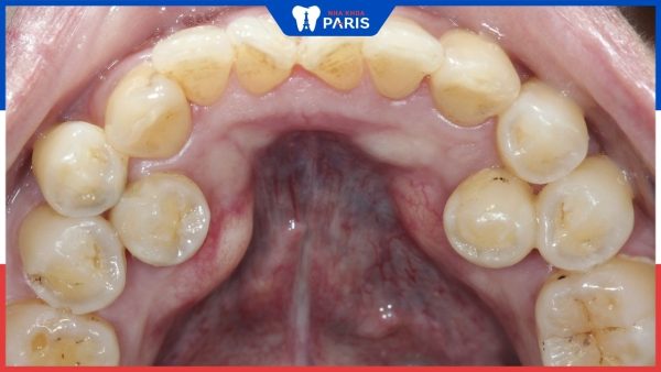 Răng vĩnh viễn mọc lệch vào trong: Nguyên nhân, cách khắc phục