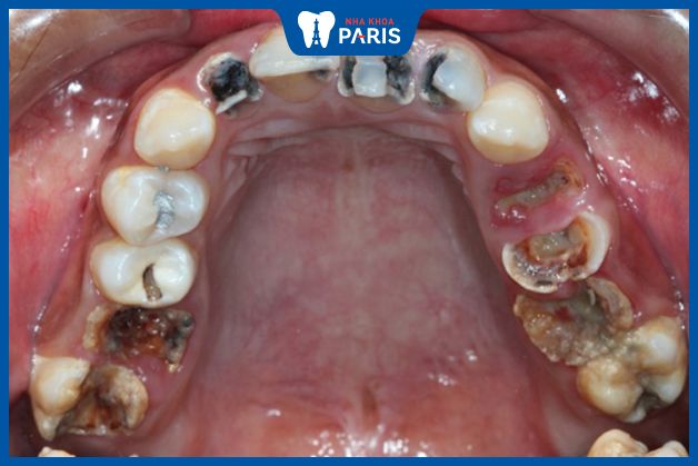 Răng bị sâu nghiêm trọng làm tủy răng lộ ra ngoài và dễ bị viêm