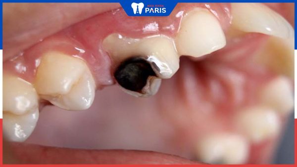 Sâu răng để lâu có sao không? Cách điều trị hiệu quả