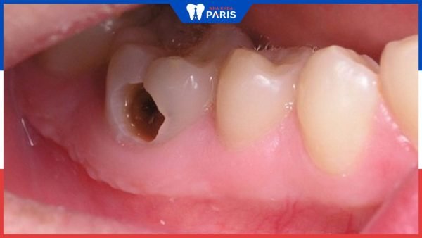 Sâu răng độ 3 nguy hiểm như thế nào? Cách điều trị hiệu quả