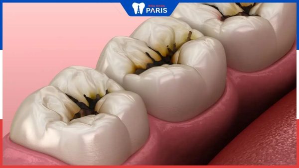 Sâu răng khi niềng răng xảy ra do đâu – Biện pháp xử lý hiệu quả