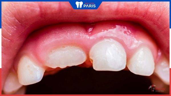 Sưng rộp nướu răng: Nguyên nhân, dấu hiệu và cách khắc phục