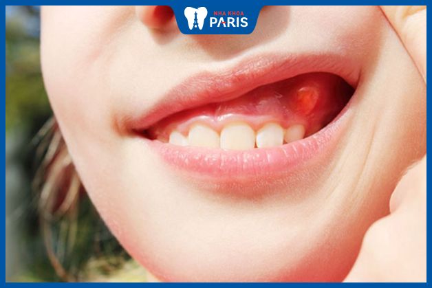 Nướu răng bị sưng rộp gây nhiều ảnh hưởng tới sức khỏe