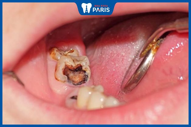 Trẻ sâu răng hàm ảnh hưởng xấu tới răng miệng