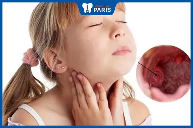 Các bệnh đường hô hấp cũng gây viêm họng h
