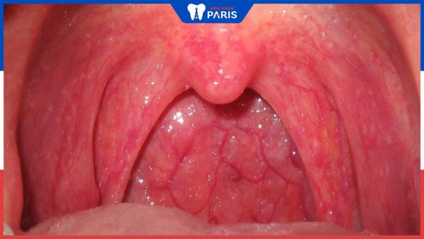 7 Triệu chứng viêm họng hạt bạn cần chú ý