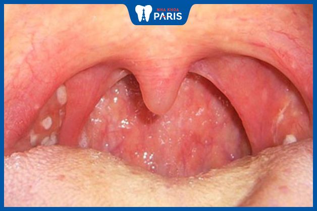 Viêm họng hạt có thể gây ung thư vòm họng