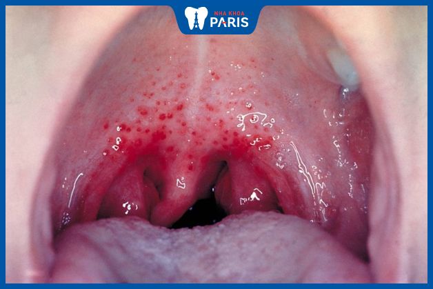 Chấm đỏ rải rác ở miệng khi bị viêm họng liên cầu