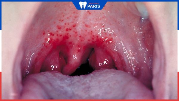Viêm họng do liên cầu khuẩn: Triệu chứng và cách điều trị