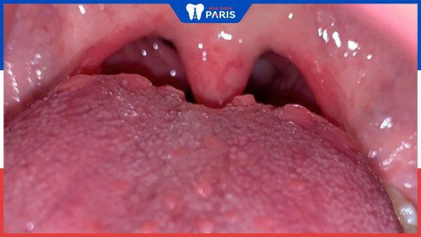 Viêm họng hạt ở lưỡi có nguy hiểm không? Làm sao để phòng tránh