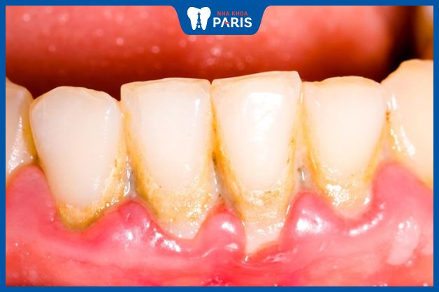 Bị viêm lợi nên lấy cao răng không