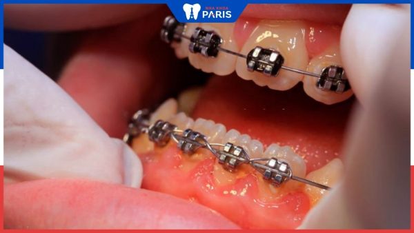 7 nguyên nhân viêm lợi khi niềng răng và giải pháp khắc phục