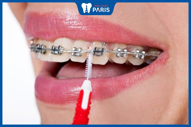 Người niềng răng mắc cài nên sử dụng bàn chải kẽ để vệ sinh răng miệng