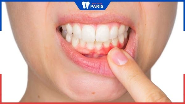 Bị viêm nha chu có niềng răng được không? Những lưu ý cần biết