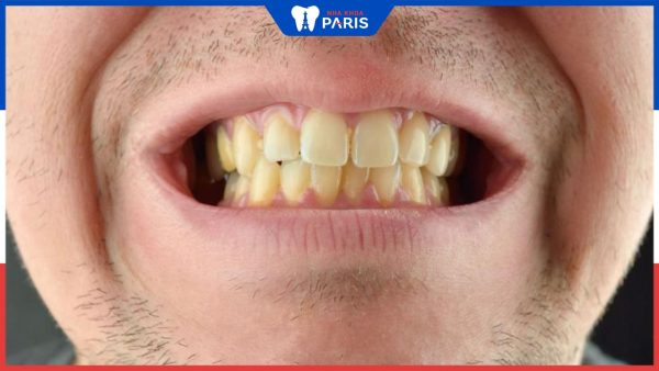 6 Cách trị răng ố vàng hiệu quả và Cách chăm sóc răng miệng