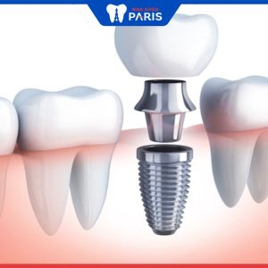 Cắm trụ răng Implant: Quy trình và thời gian thực hiện