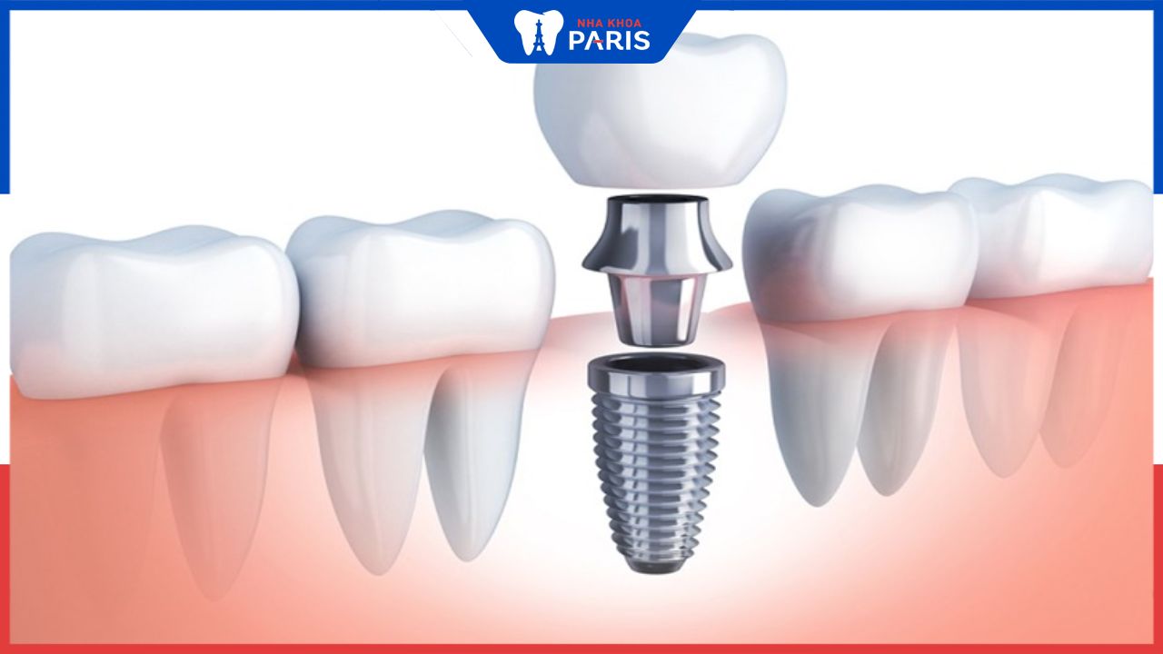 Tìm hiểu về cắm trụ răng Implant: Lợi ích và quy trình thực hiện