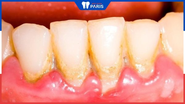 Cao răng độ 2 ảnh hưởng thế nào – Biện pháp làm sạch cao