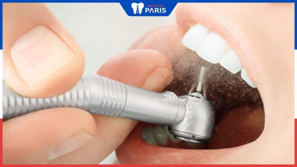 5 Lưu ý quan trọng khi chăm sóc răng sau khi mài