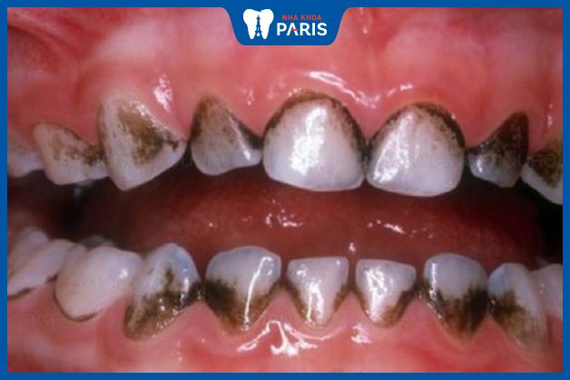Chân răng đen ảnh hưởng đến sức khỏe răng miệng