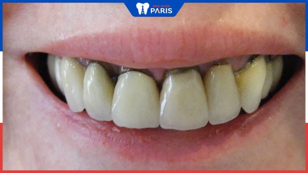 Chân răng bị đen là bệnh gì? Các biện pháp khắc phục