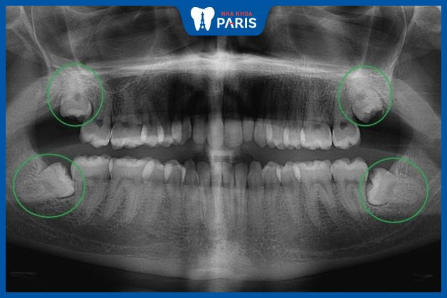 Hình ảnh X-quang răng khôn mọc ngầm