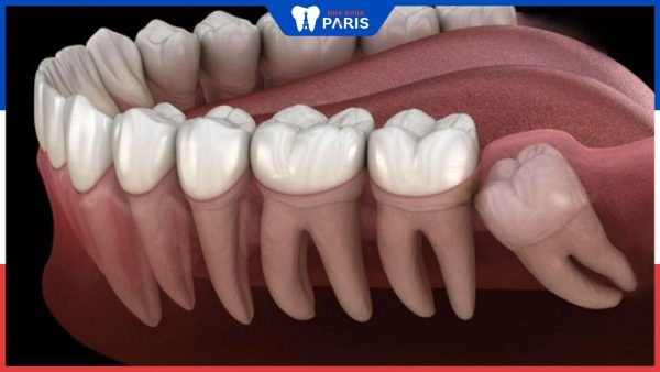 Tổng hợp 8 dấu hiệu nhận biết răng khôn mọc ngầm