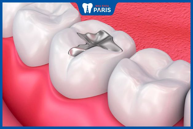 Hàn răng giúp tăng độ bền chắc của răng