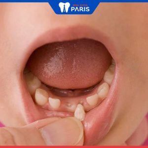 Thời điểm phù hợp nhất để nhổ răng sữa cho bé và một số lưu ý