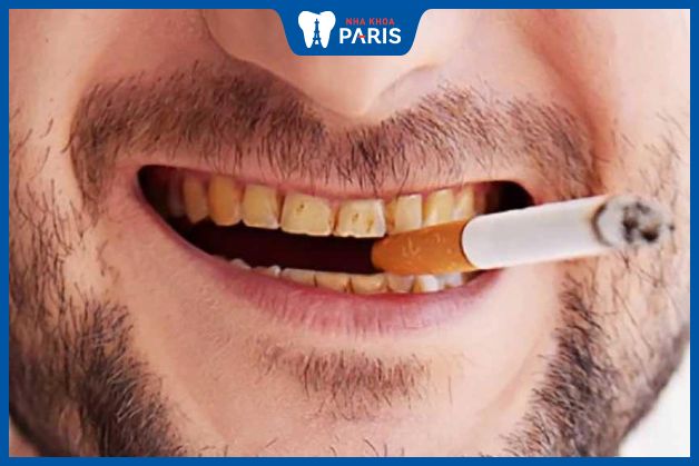 Hút thuốc lá ảnh hưởng đến sức khỏe răng miệng