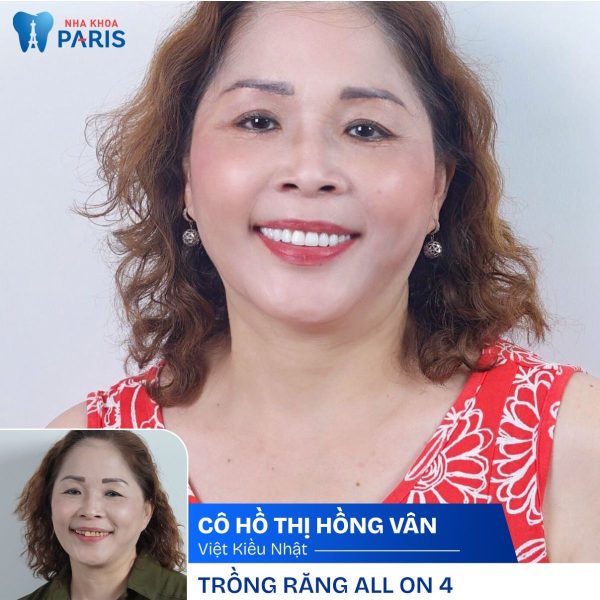 Khách hàng Việt Kiều nói gì khi trồng răng tại Nha khoa Paris